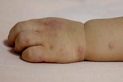 Image of Information about Hand, foot and mouth disease