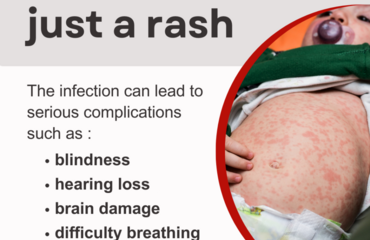 Image of What is measles and why is the MMR vaccine so important?