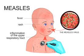 Image of Measles Information Letter